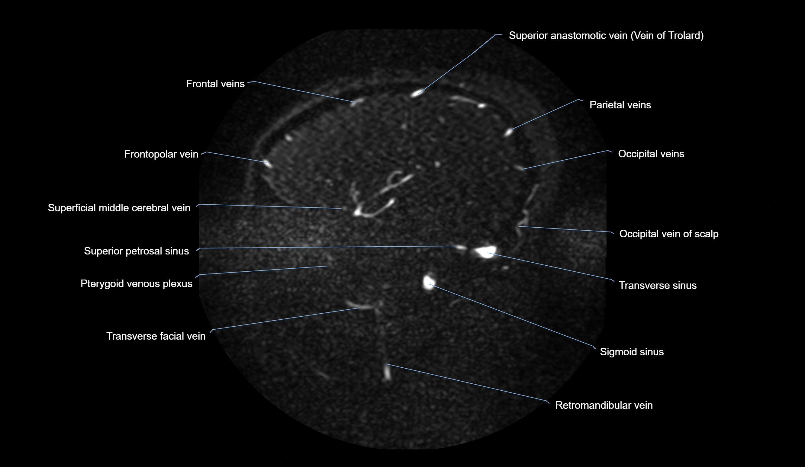 MRV brain sagittal anatomy 3T MRI images -img-01015-00064.webp
